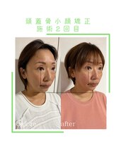 ヴィヴァーチェ(VIVACE)/頭蓋骨小顔矯正ビフォーアフター