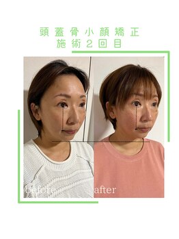 ヴィヴァーチェ(VIVACE)/頭蓋骨小顔矯正ビフォーアフター