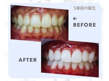 スマイルホワイト 練馬店/ホワイトニングビフォーアフター