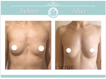 美人バスト 岡山店/バストアップ・バストケア症例★