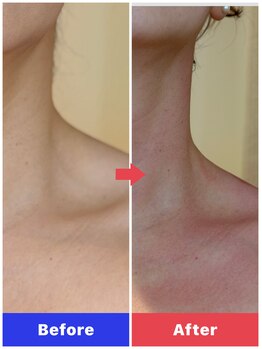 フィロ柏整骨院(Philo柏整骨院)/胸鎖乳突筋ほくし！首肩スッキリ