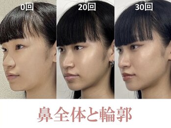 ラプリシュシュ 岡山店(Raplit)/隆鼻+輪郭矯正40分30回