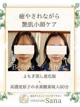 ヨサパーク サーナ 仙川(YOSA PARK Sana)/20代お客様ビフォー⇒アフター