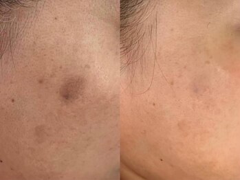 シミケア専門店 SAKURA 平塚店/平塚シミケア/伊勢店シミケア