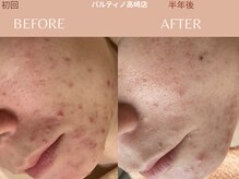 パルティノ 高崎店の雰囲気（ニキビケア・あかみ・お任せください◎敏感肌の方の為のケア可能）