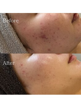 ルラシェ(Relacher)の写真/【繰り返すニキビ・肌荒れ】徹底改善◎肌育ハーブ・美容導入で透明感あふれるツヤ肌へ