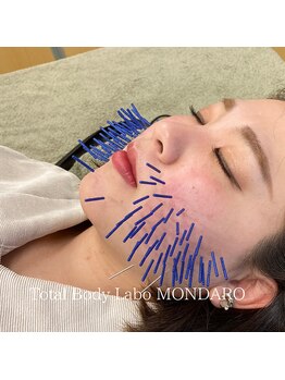 モンダロ(MONDARO)/美容鍼