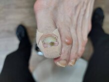 爪切り屋 足楽/変色爪のケアafter