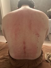 ホスピー(Hosppy)/カッサでデトックス