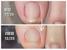 エーケーネイル(AKnail)の雰囲気（巻き爪補正）