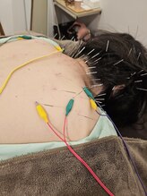 はりきゅう和 ルート鍼灸院/肩こり