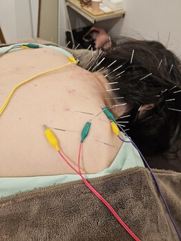 はりきゅう和 ルート鍼灸院/肩こり