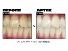 トムズ(Tom’s)/歯のセルフホワイトニング♪