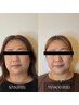 【小顔+ダイエット】フェイスライン1回りサイズダウン!!美容鍼灸 ¥3,300