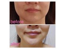 パルティール(PARTIR)/小顔マシン利用♪