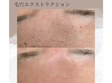 ベルーテ 田町三田(Bellute)/額の毛穴もリセット★