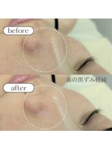 ケアプラス/鼻の黒ずみ改善