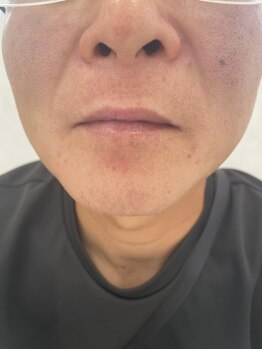 セルフメイド サンリブしみず店(SELFMADE)/ヒゲ撃退モード