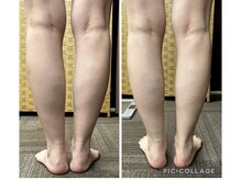 テラスアップ(Terrace UP)/【脂肪分解マシン】ふくらはぎ