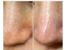 サイ(Sai)/毛穴ケア９回後の変化