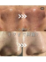 シエル 美里店(ciel)/毛穴洗浄と炭酸パック