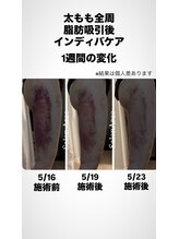サロンアルセ 恵比寿(Salon Arce)/ダウンタイム促進ケア