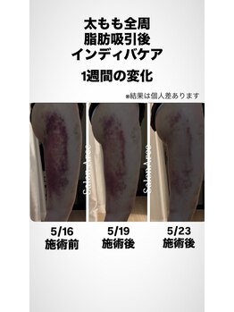 サロンアルセ 恵比寿(Salon Arce)/ダウンタイム促進ケア