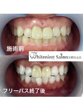 ホワイトニングサロン 京都烏丸店/ホワイトニング施術例