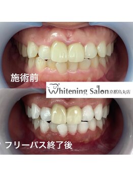 ホワイトニングサロン 京都烏丸店/ホワイトニング施術例