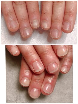 スマイルニコ(smile nico)/深爪矯正【長さ出し有】自爪風