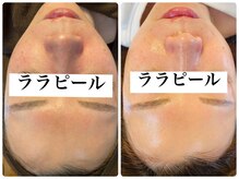 エスサロン(S.salon)の雰囲気（水光肌・毛穴縮小・くすみ肌にはララピール。一回で効果大）