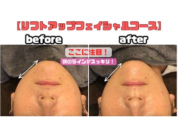 やけの鍼灸整骨院/EMSによるリフトアップ施術