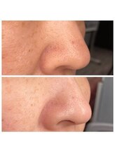 かれん/ハイドラ毛穴コース