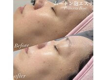 キレイシェア バイ プリンセスローズ静岡駅店(KIREI SHARE)/ムートン泡エステ