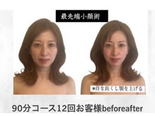 「糸に頼らない。10歳見違える。上品リフトアップ専門。」