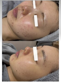 エラン(ELAN)/ニキビ肌質改善【Dr,sハーブ】