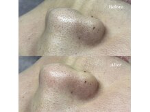 ホワイトワックス 浜松(WHITE WAX)/鼻の黒ずみすっきり解消