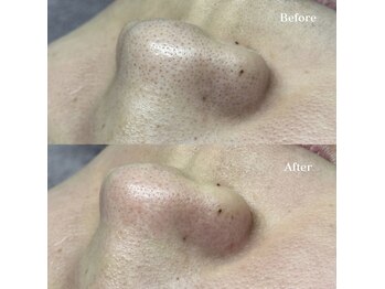 ホワイトワックス 浜松(WHITE WAX)/鼻の黒ずみすっきり解消