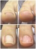 【巻き爪・陥入爪補正・両親指】90分¥19800【口コミを書いていただける方】