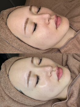 COR Beauty【肌質改善/韓国ララピール/メンズアイブロウ/眉ワックス/まつげパーマ】の写真/話題のピーリングで肌質改善◎シミやたるみにお悩みの方へ！透明感あふれるツヤ肌へ導く本格フェイシャル