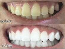 グラーティア 梅田店(gratia)/ホワイトニング★6ヶ月目★