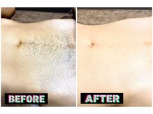 メンズスリーナインサロン(Men's ThreeNines Salon)/Vライン～へそ周り脱毛