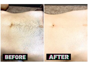 メンズスリーナインサロン(Men's ThreeNines Salon)/Vライン~へそ周り脱毛