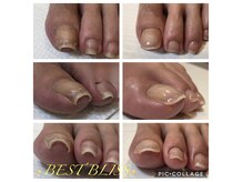 ベスト ブリス(Best Bliss)の雰囲気（特許取得の巻き爪補正。巻き爪になってしまう理由をお伝えします）