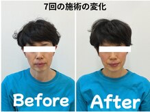ゆず鍼灸整骨院/7回で見た目年齢-5歳 美容鍼整体