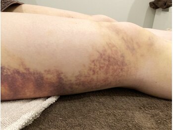 サロンドブーケ 上本町店(salon de bouquet)の写真/《美容術前術後インディバ専門店》術前術後どちらにも使える3回集中コースで早期回復を徹底サポート!