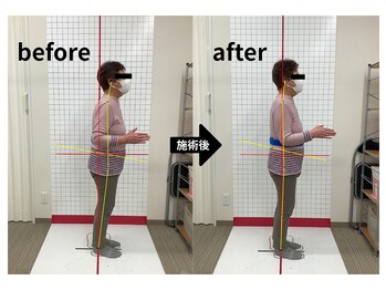 ほねつぎ龍ヶ崎はりきゅう接骨院/【骨盤矯正】before/after
