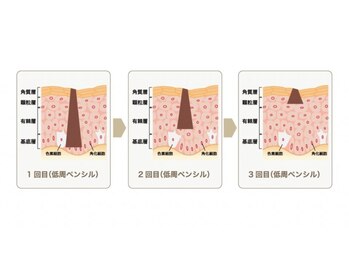 ハドゥ(Ha-DU)/シミケアの仕組み