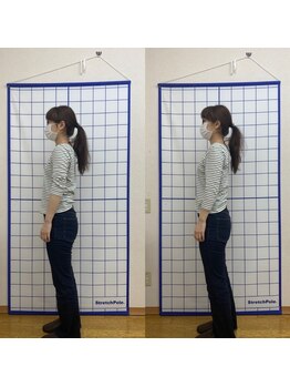 池川整骨院/姿勢矯正ビフォーアフター