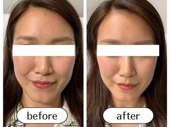 オリガミ鍼灸接骨院 旭丘院/【Before/After】小顔美容鍼